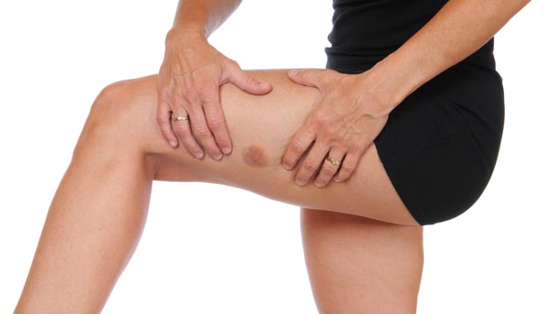 Photo of 7 Tips to Stop Injection Site Bruising
