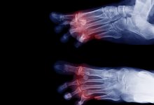 Photo of Lower Extremity Amputations Are Most Common in Type 1 Patients