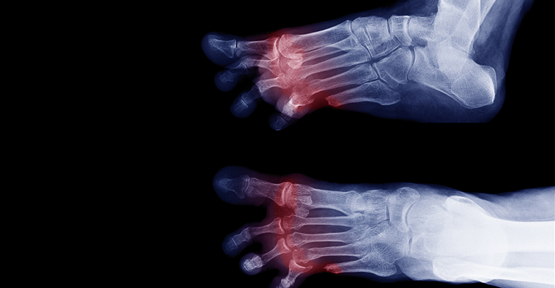 Photo of Lower Extremity Amputations Are Most Common in Type 1 Patients